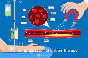 คีเลชั่นบำบัด (Chelation Therapy) การล้างพิษหลอดเลือด เทคโนโลยีการแพทย์